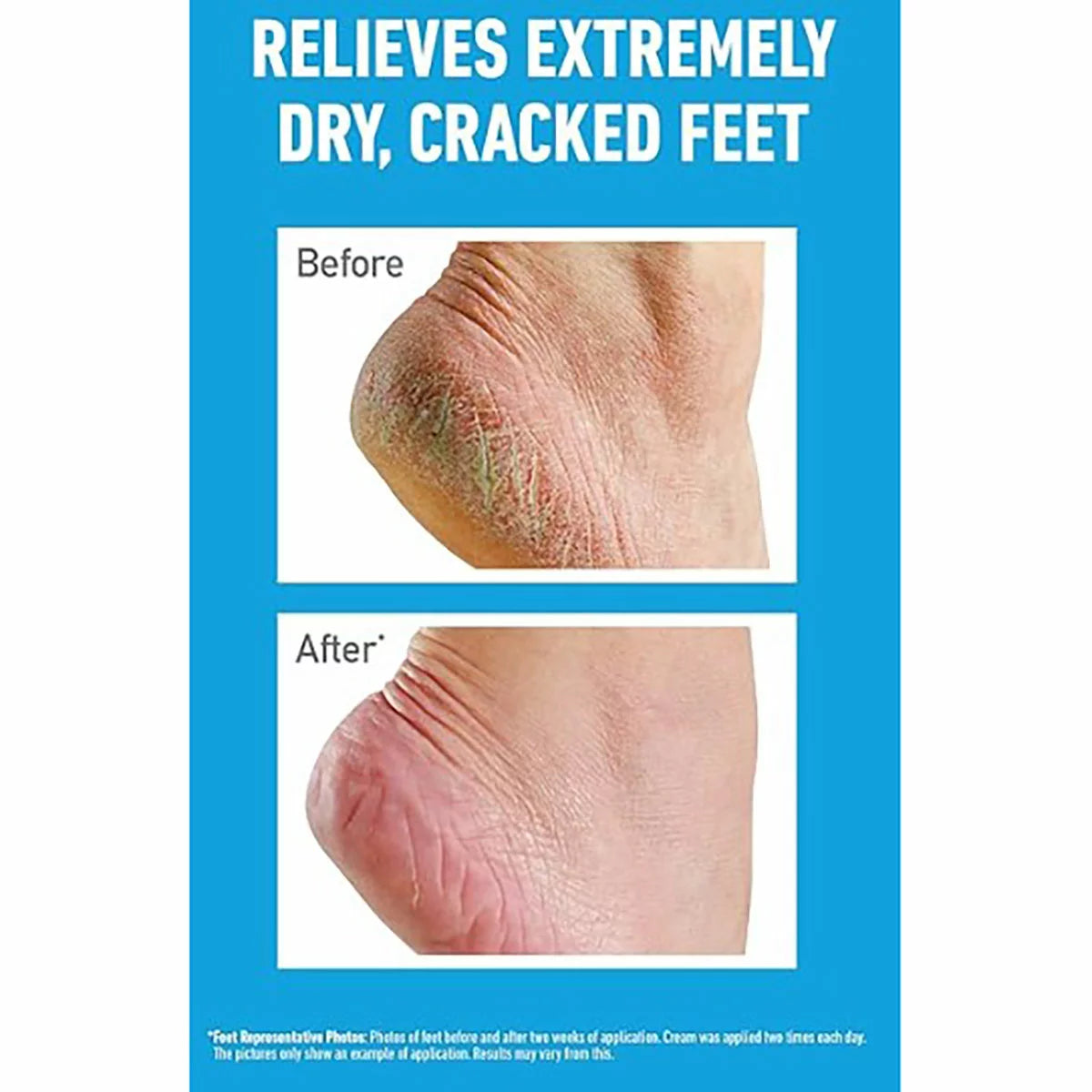 Foot repair cream for extremely dry skin